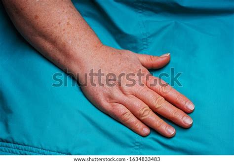 Hands Elderly Woman Pigmentation Protruding Veins Stock Photo