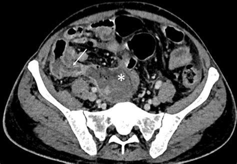 Axial Ct Image Of A 62 Year Old Man Obtained At The Level Of The Root