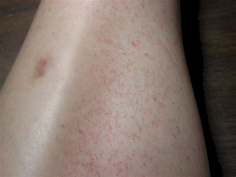 Itchy Lumps Under Skin On Arms Small Red Spots Under Skin