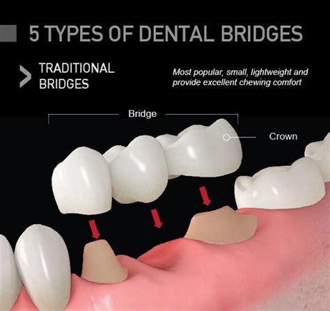 Tipos de puentes dentales Qué tipo es el mejor para mí 2023