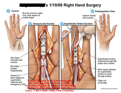 Amicus Illustration Of Amicus Surgery Hand Brunner Bruner Incision Volar Aspect Middle Finger