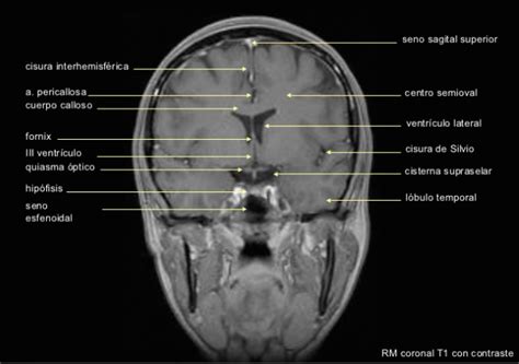 Resonancia Magnetica T Coronal Con Contraste Craneo Radiolog A Estudiante De Radiolog A