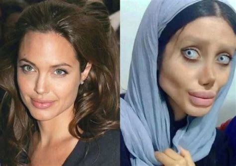 Plastic Surgery Gone Wrong Before And After Pictures
