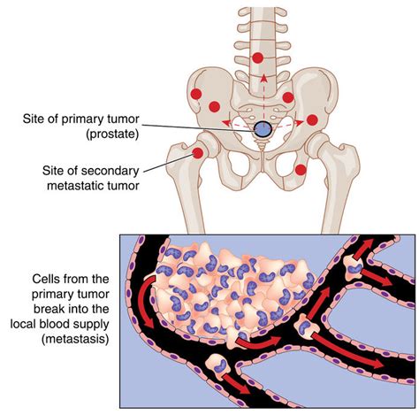 Back pain isn't one of the hallmark symptoms of breast cancer. Spinal Tumors: Descriptive Overview