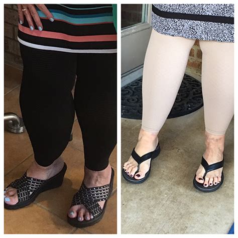 Lipedema Liposuction To The Legs Before And After Photos Lipedema