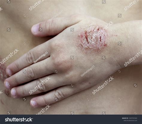 Case Nummular Dermatitis Nummular Eczema Child Foto Stok 1325791922