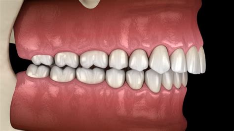 Protruding Teeth Causes And Advice Treatment In Bassendean