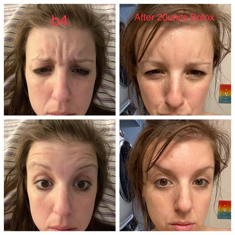31f Botox B4 And After First Time No Skin Care Regimen I Just Try