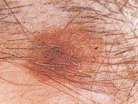 Melanoma The Deadliest Skin Cancer Skin Cancer Or Mole How To Tell