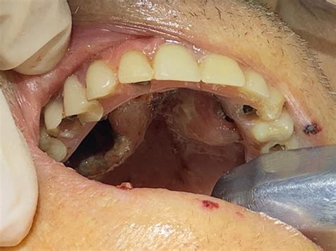 Scielo Brasil Treatment Of Oral Myiasis In A Patient With Implant Supported Fixed Prosthesis