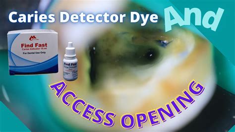 ⚪️caries Detector Dye🟣access Opening🟢 Youtube
