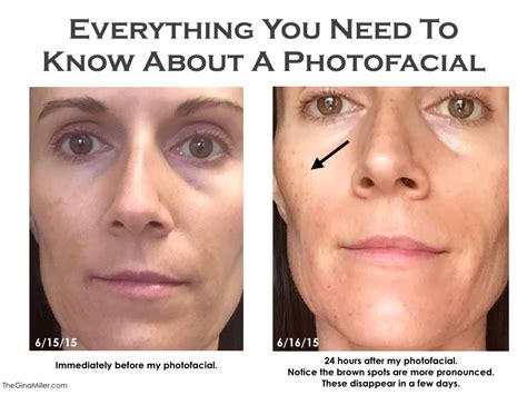 Photofacial Review Everything You Need To Know About This Gamechanging