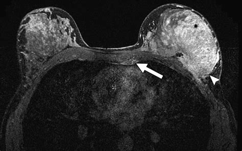 Detection Of Internal Mammary Adenopathy In Patients With Breast Cancer