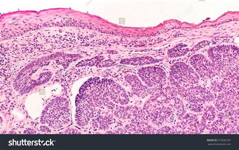Skin Biopsy Pathology Basal Cell Carcinoma Stock Photo Royalty Free