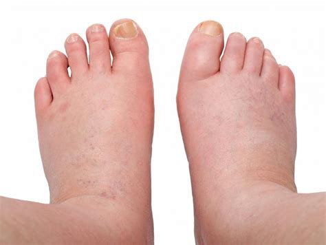 What Are The Most Common Causes Of Foot Swelling