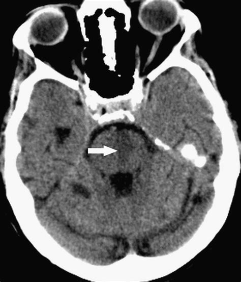 Basilar Artery Occlusion Prognostic Signs Of Severity On Computed