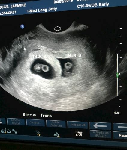 10 Weeks Pregnant Ultrasound Twins