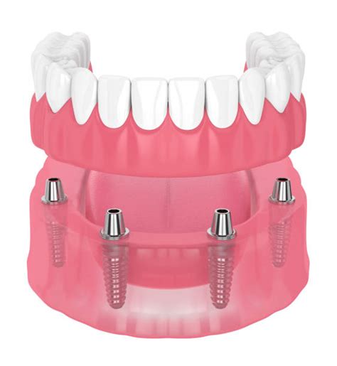 Implant Denture Stock Photos Pictures And Royalty Free Images Istock