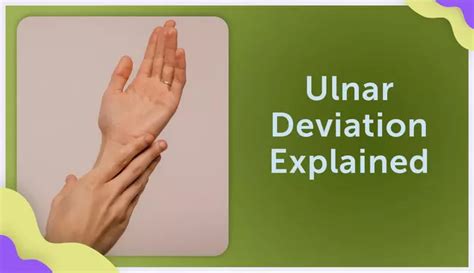 Ulnar Deviation Explained Myrateam