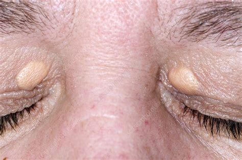 Xanthelasma On The Eyelids Stock Image C0155956 Science Photo