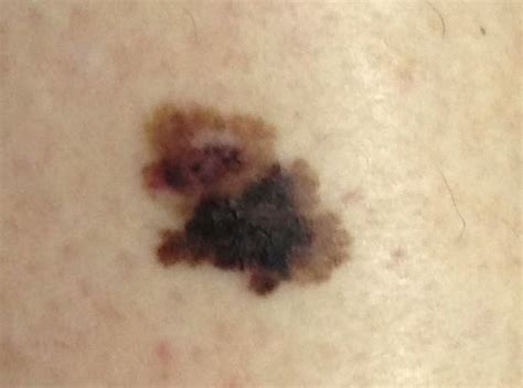What Skin Cancer Can Look Like Do You Know How To Identify Early