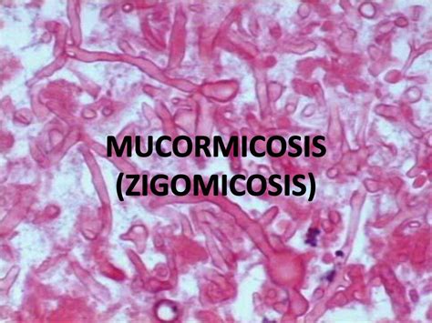 Nathalie quiroz1, janeth del pilar villanueva2, edgar andrés lozano3. PPT - MUCORMICOSIS (ZIGOMICOSIS) PowerPoint Presentation ...