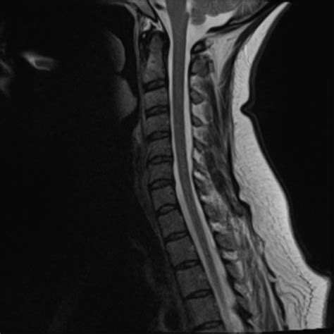 Normal Cervical Spine Mri Including Dixon Sequences Image