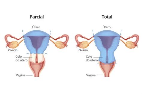 Histerectomia o que é indicações tipos e cuidados pós operatório
