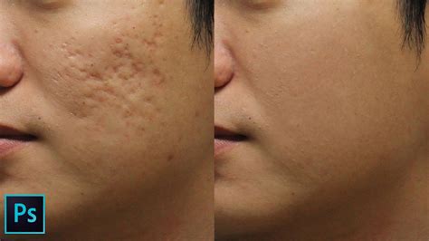 How To Remove Holes Caused By Acne Scars In Photoshop Split Frequency