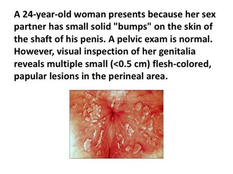 Infectious Causes Of Vaginal Discharge Flashcards Quizlet