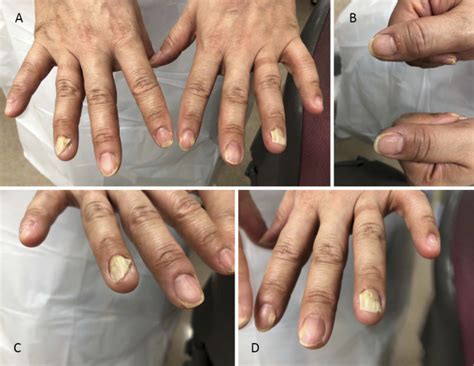 Plummers Nails Onycholysis In A Thyroid Stimulation Blocking Antibody Tsbab Positive