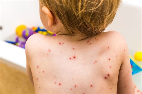 Chickenpox Facts Diseases Of The World