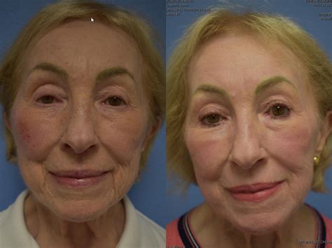 Co2 Laser Resurfacing Before And After Photos Patient 242 San Francisco