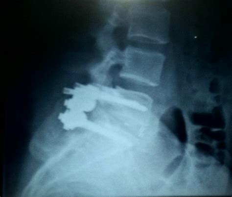 My L5 S1 Spinal Fusion 1st Set Of X Rays Second Post Op Visit W