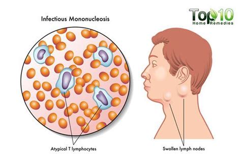 Do you know what mononucleosis symptoms look like? Mononucleosis Explained: Causes, Symptoms and Natural ...