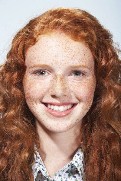 What Are The Scientific Reasons For Freckles Education Seattle Pi