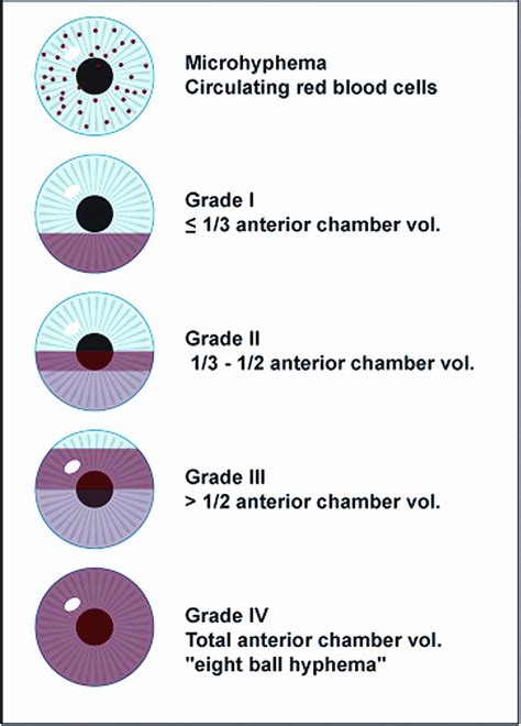 Hyphema Grading System American Academy Of Ophthalmology