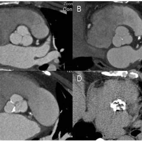 Assessment Of Aortic Valve Calcification By Dual Source Computed