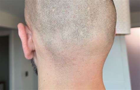 How To Prevent And Treat Razor Bumps On The Back Of Your Head