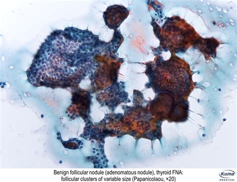 Pathology Outlines Multinodular Goiter