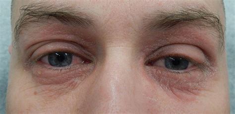 Periocular Dermatitis Around Eyes