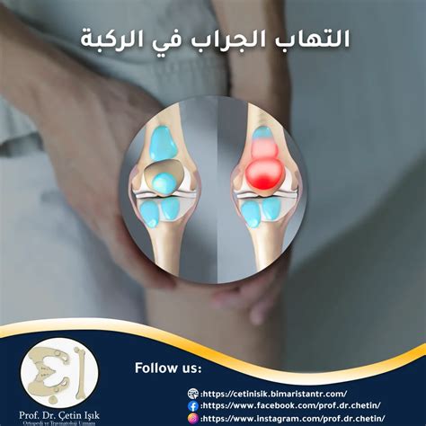 التهاب الجراب في الركبة