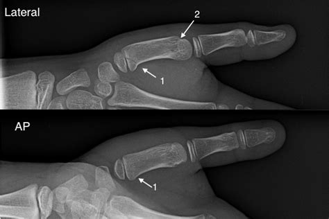 Thumb Metacarpal Pediatric Fracture Hand Surgery Source