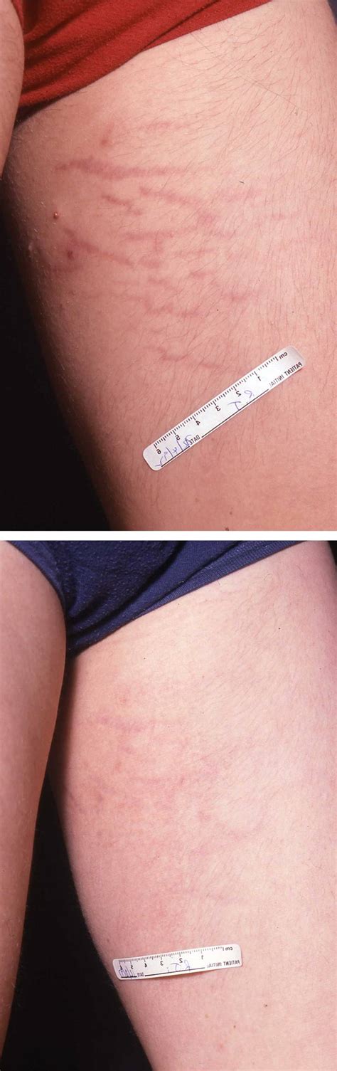 Stretchmark Removal Sydney Nsw Áda Aesthetic Medicine