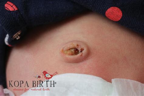 If the cord wasn't cut the placenta detaches here. Baby Umbilical Cord Falling Off - What's Normal? | Kopa Birth®