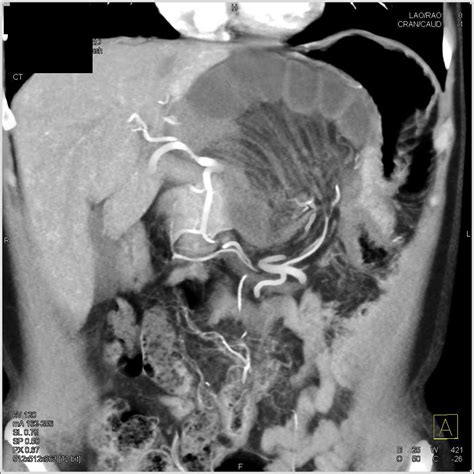 Internal Hernia With Midgut Volvulus With Small Bowel Obstruction And