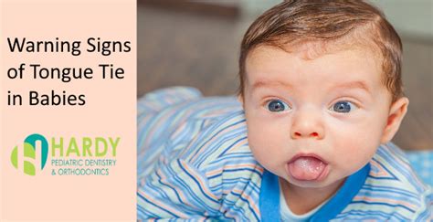 7 Warning Signs Of Tonge Tie In Infants Hardy Pediatric Dentistry
