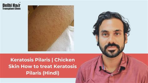 Keratosis Pilaris Chicken Skin How To Treat Keratosis Pilaris