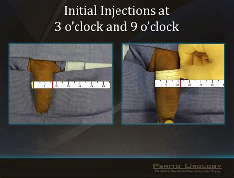 Penile Girth Augmentation Before And After Erectile Dysfunction Treatment Fort Lauderdale