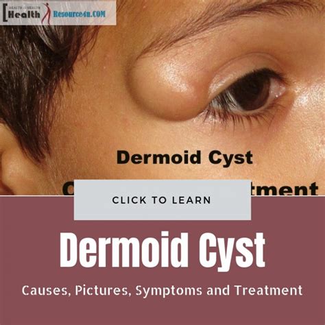 Dermoid Cyst Definition Causes Symptoms And Dermoid Cyst Treatment